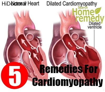 Cardiomyopathy1