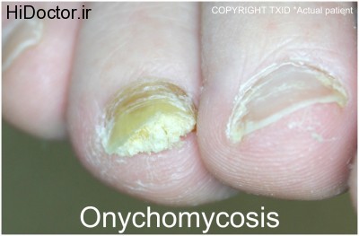 Onychomycosis-Cropped