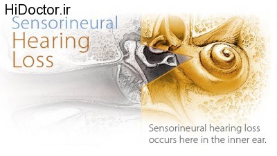 Sensorineural-Hearing-Loss-676x381-675x380