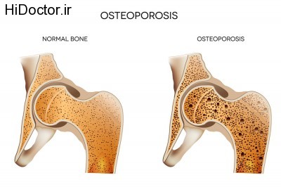 bigstock-Osteoporosis-44323384