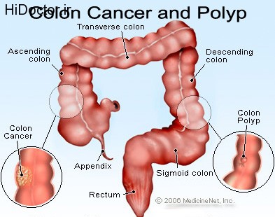 colon_cancer