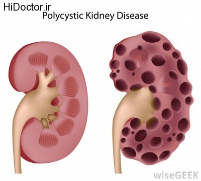 polycystic-kidney-disease