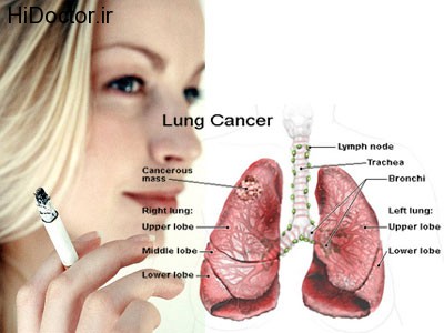 signs-of-lung-cancer-in-women