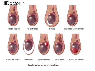 testicular