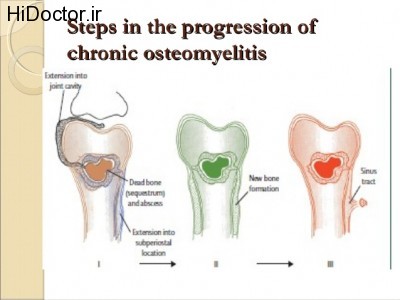 seminar-on-chronic-osteomyelitis-sch-11-638