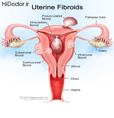 uterine-fibroids