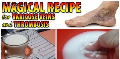 Recipe-for-Varicose-Veins-and-Thrombosis