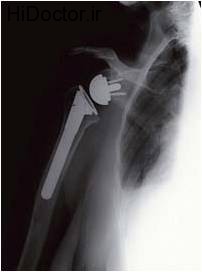 Shoulder joint replacement3