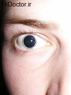230px-Dilated_pupils_2006
