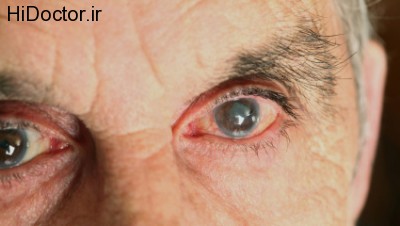 eyes-glaucoma