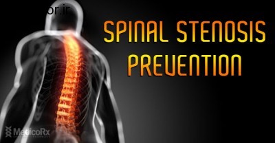 spinal-stenosis-prevention