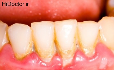 Dental-plaque