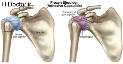 Frozen-shoulder