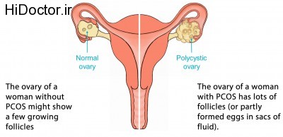 PCOS