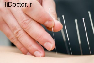 acupuncture-treatment-may-help-with-fibromyalgia-pain-300x201