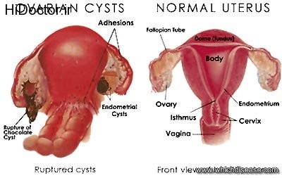 benign-ovarian-tumors