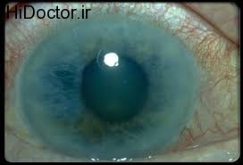 glaucoma1