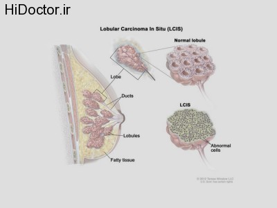 Breast Lobular Carcinoma