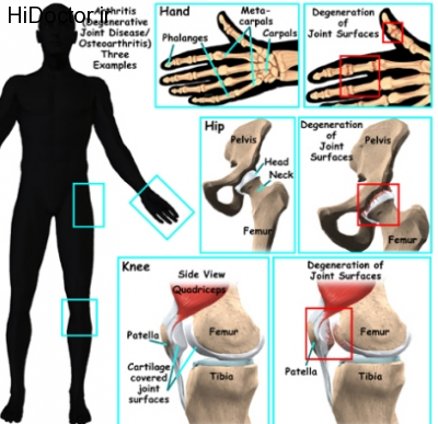 stem-cell-therapy-for-arthritis