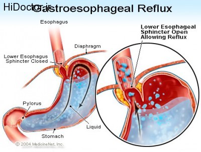 gastroesophageal_reflux