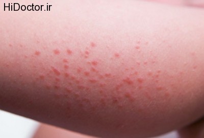 sun-allergy-rash-pictures-5