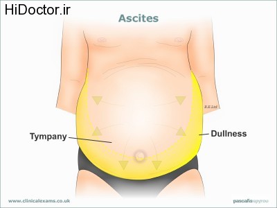 Ascites-web-large800x600