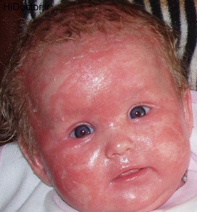 Ichthyosis-3