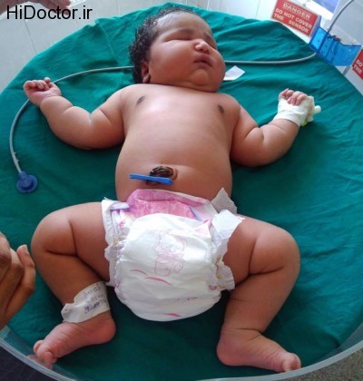 نتیجه تصویری برای چاقی قبل از بارداری و نوزاد مریض
