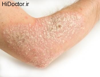 Psoriasis and obesity
