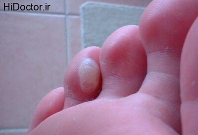 blister