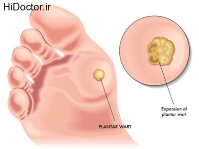 plantar-wart-500