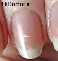 white-spots-in-nails-1-nailcarehq