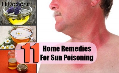 11-Home-Remedies-For-Sun-Poisoning