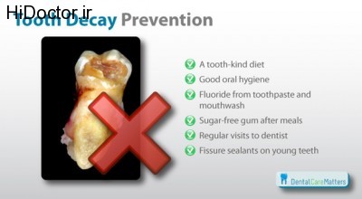 Tooth-Decay-prevention