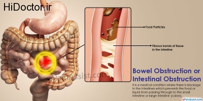 bowel-obstruction