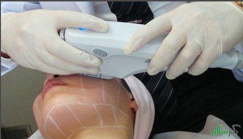 هایفوتراپی جدیدترین روش برای کشیدن پوست