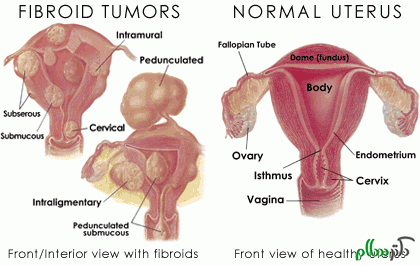 education-fibroid-tumors