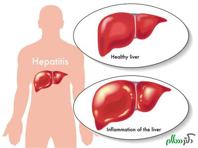 hepatitis-1