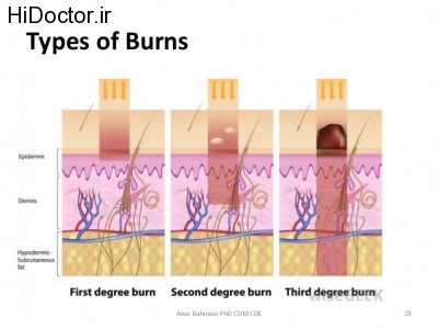 lecture-four-burns-first-aid-25-638
