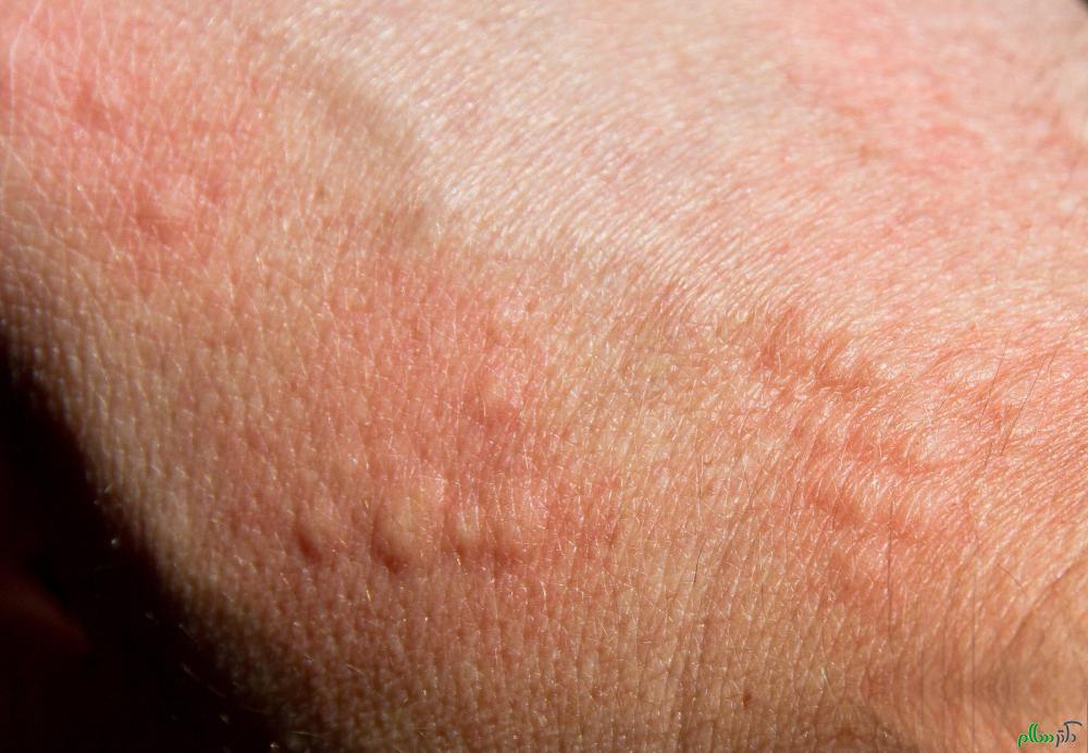 skin-hives-on-arm