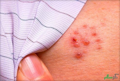 493x335_psoriasis_ra_and_shingles