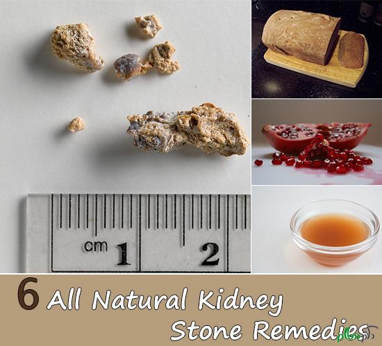 6-All-Natural-Kidney-Stone-Remedies