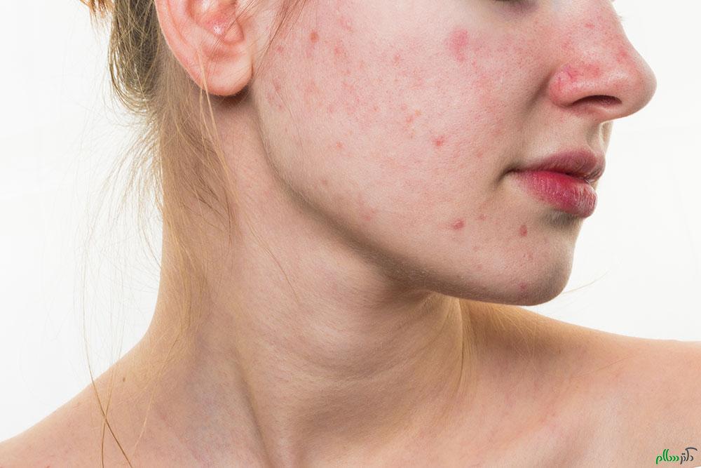 ACNE-ROSACEA