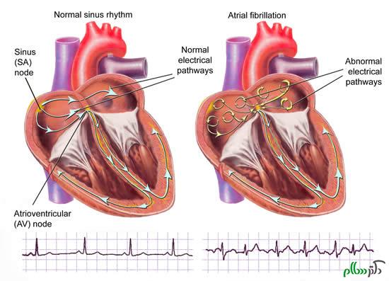 Arrhythmia-of-the-heart-what-to-do-when-a-cardiac-arrhythmia