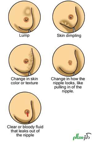 En_Breast_cancer_illustrations