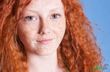 Get-Rid-Of-Freckles