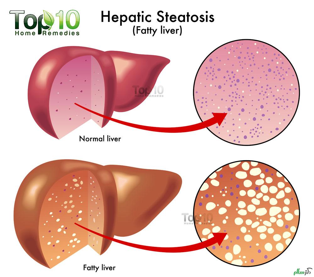 Hepatic-Steatosis