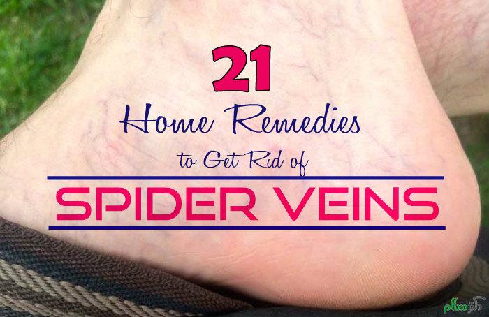 Home-Remedies-to-Get-Rid-of-Spider-Veins-700x4541