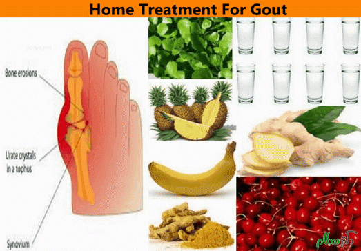 Home-Treatment-For-Gout