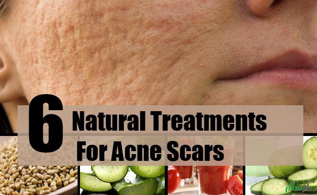 Natural-Treatments-For-Acne-Scars